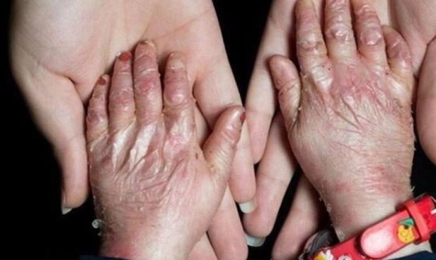 آمریکا در پرونده “تحریم کودکان پروانهای” محکوم شد آمریکا در پرونده “تحریم کودکان پروانهای” محکوم شد